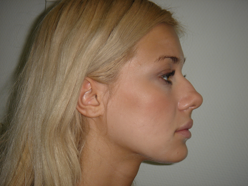 How to remove nose skin excess?. Aesthetically reasonable approach